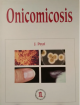 Onicomicosis